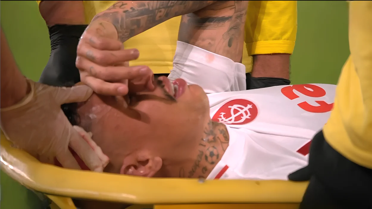 Richard sofre corte na cabeça e deixa o campo no 1º tempo de Fluminense x Inter Richard sai de maca, após choque de cabeça com Everaldo, no jogo do Inter contra o Fluminense, na Copa do Brasil